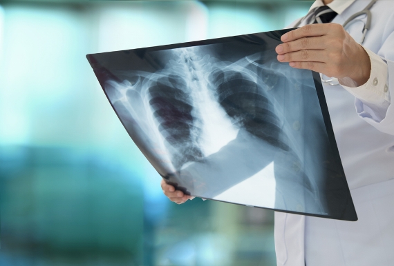 OMS publica novas recomendações para acelerar progressos contra a tuberculose