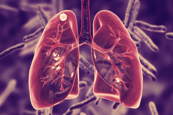 Progresso para acabar com tuberculose nas Américas deve ser acelerado, afirma OPAS