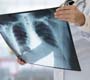 OMS publica orientação ética para proteger direitos dos pacientes com tuberculose