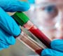 Pesquisa indica diagnóstico de tumores através de exame de sangue