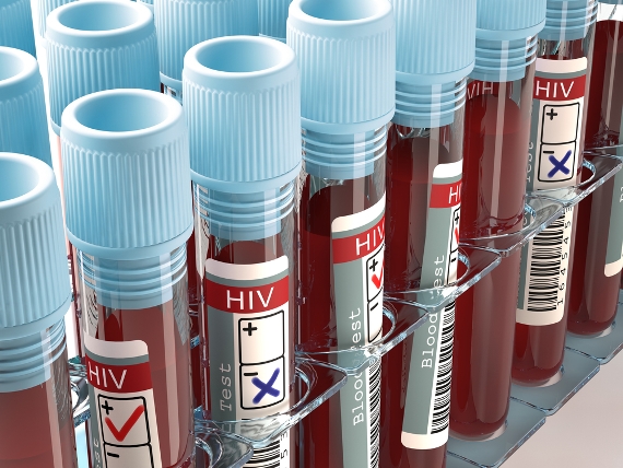 75% das pessoas com HIV no mundo conhecem seu estado sorológico