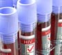 Diagnóstico tardio do HIV é maior obstáculo para combater vírus