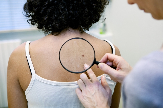 Câncer da pele: pintas que mudam de cor, tamanho e formato são alerta