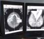 Ministério da Saúde anuncia a criação de um programa de mamografia móvel