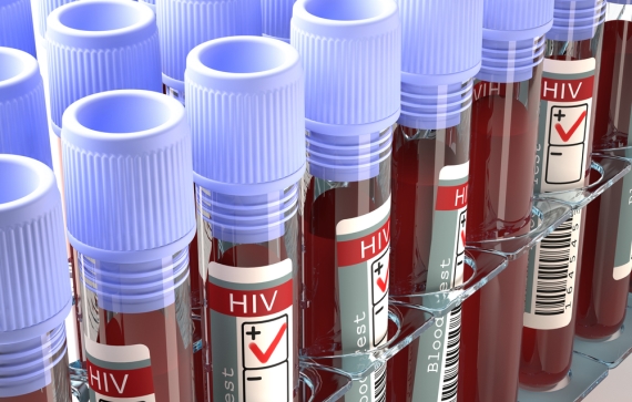 Diagnóstico tardio do HIV é maior obstáculo para combater vírus