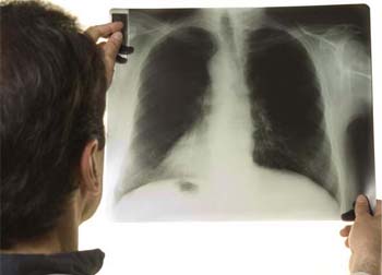 Dia Mundial de Combate à Tuberculose serve de alerta para a alta incidência da doença e necessidade de tratamento continuado