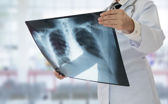 OMS publica orientação ética para proteger direitos dos pacientes com tuberculose