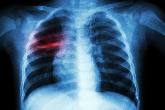 Dia Estadual de Conscientização, Mobilização e Combate à Tuberculose: a importância do diagnóstico e a prevenção da tuberculose