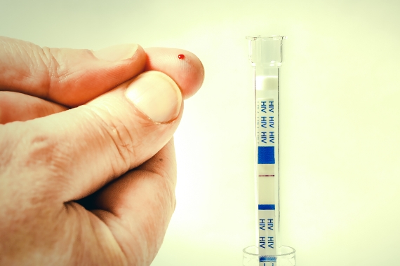 Teste é apontado como primeiro passo para prevenir HIV e interromper epidemia de aids