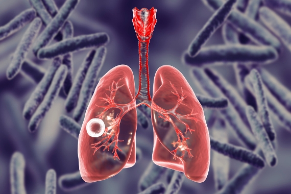 Tuberculose provoca uma em cada três mortes relacionadas à AIDS no mundo