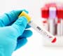 HIV: quando fazer o exame?
