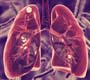 Progresso para acabar com tuberculose nas Américas deve ser acelerado, afirma OPAS