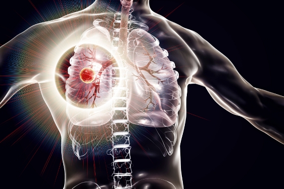 OMS pede ação urgente para acabar com a tuberculose