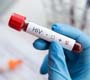 Teste rápido de HIV: saiba o resultado em 30 minutos