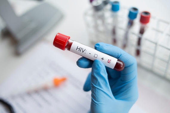 Teste rápido de HIV: saiba o resultado em 30 minutos